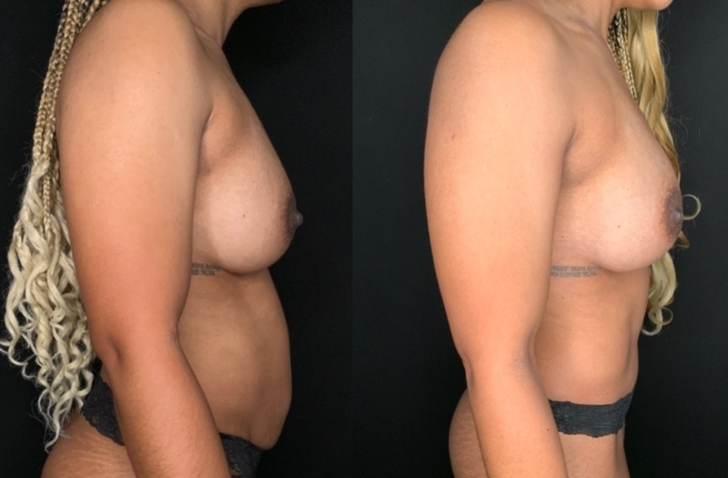 Patient #68942: Mommy Makeover Combine Image