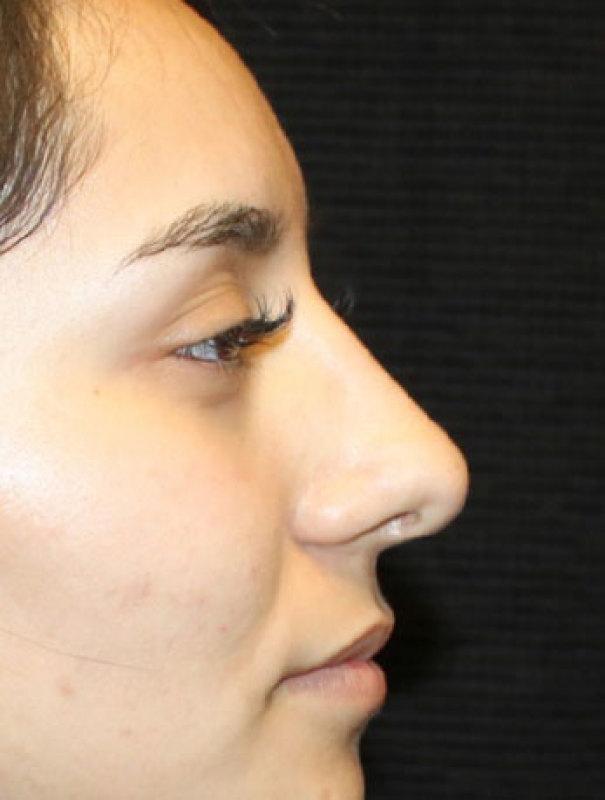 Patient #27507: Rhinoplasty After Image