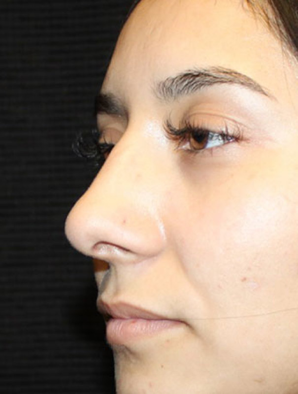 Patient #27507: Rhinoplasty After Image