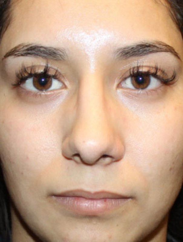 Patient #27507: Rhinoplasty After Image