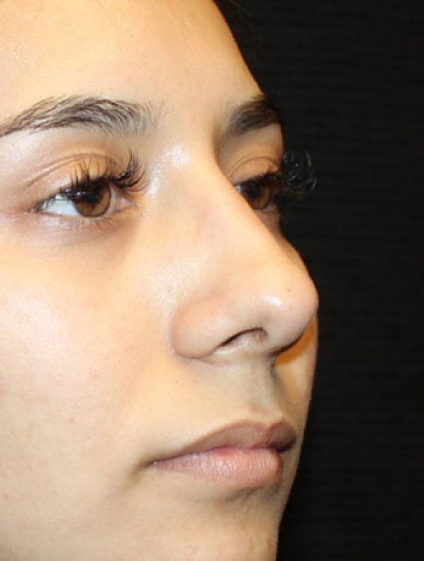Patient #27507: Rhinoplasty After Image