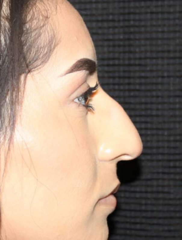 Patient #27507: Rhinoplasty Before Image