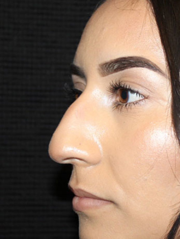 Patient #27507: Rhinoplasty Before Image