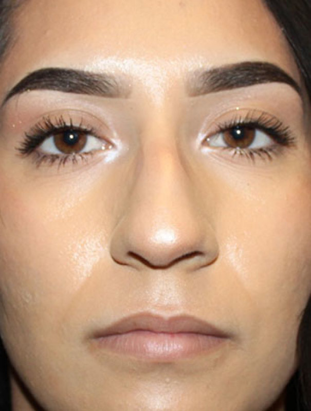 Patient #27507: Rhinoplasty Before Image