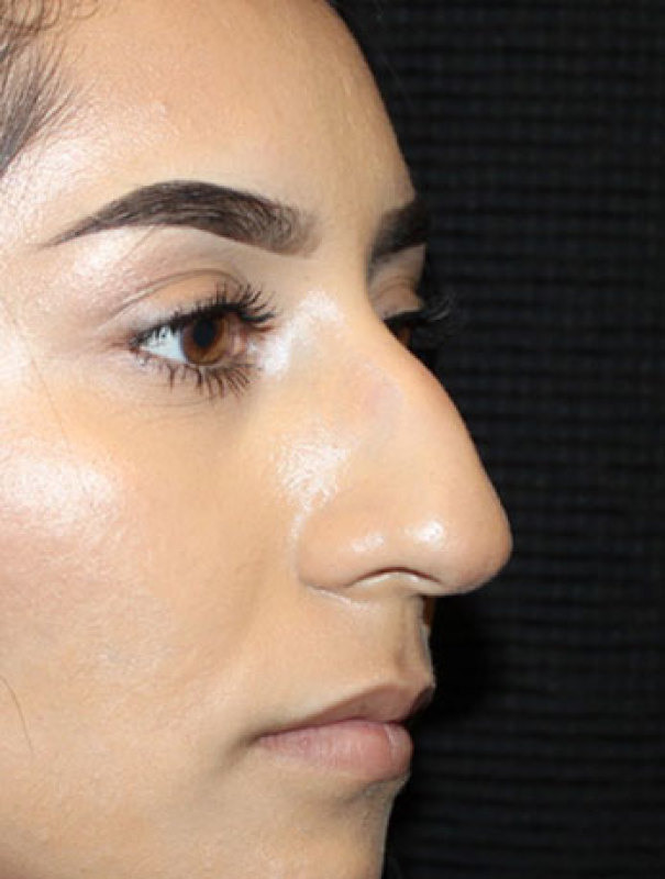 Patient #27507: Rhinoplasty Before Image